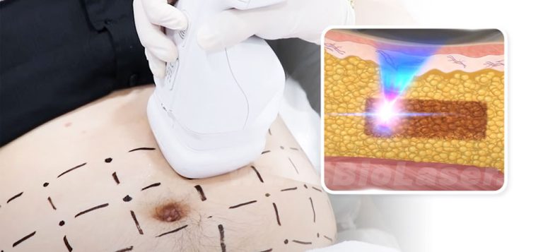 Hifu-Body-sculpting-biolaser.ir
