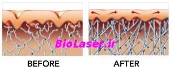جوانسازی پوست با لیزر